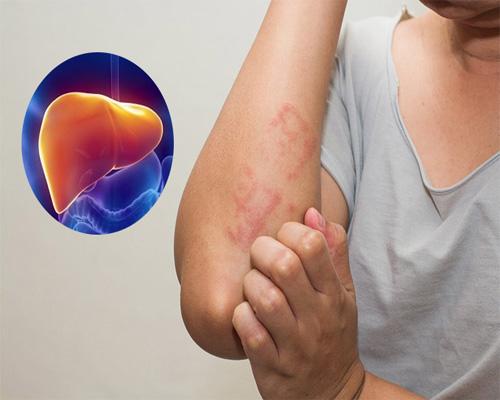 Tìm hiểu sẩn ngứa do gan có nguy hiểm không?