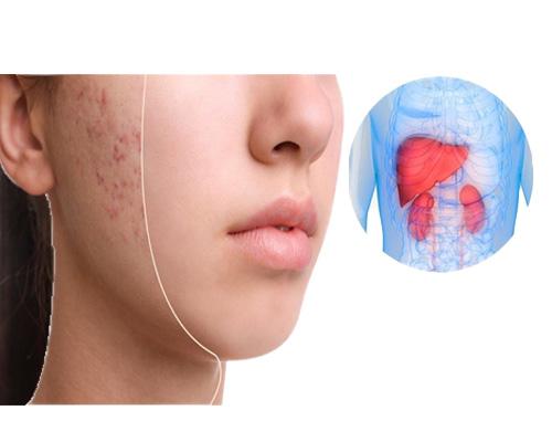 Uống thải độc gan có hết mụn không? 5 lầm tưởng phổ biến cần tránh