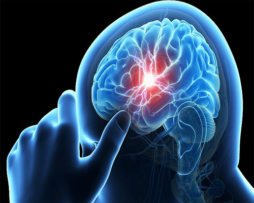 Thiếu máu não có triệu chứng gì và có nguy hiểm không?