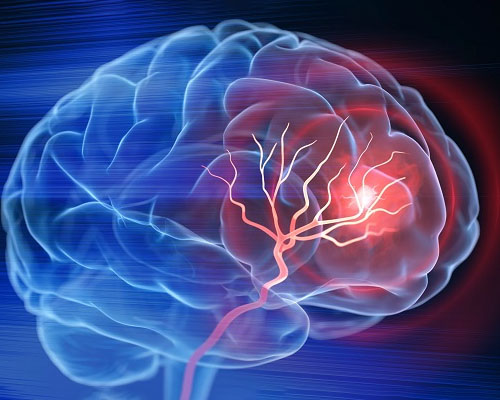 Thiếu máu não nên làm gì để cải thiện sức khỏe?