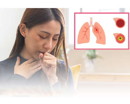 Thuốc điều trị viêm phế quản nào hiệu quả nhất hiện nay?