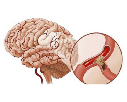 Tai biến mạch máu não là gì? Các thuốc điều trị sau tai biến
