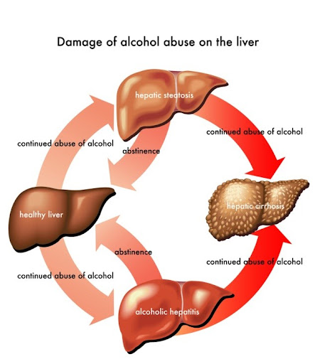 Viêm gan do rượu: Nguyên nhân, dấu hiệu, phương pháp phòng ngừa và điều trị