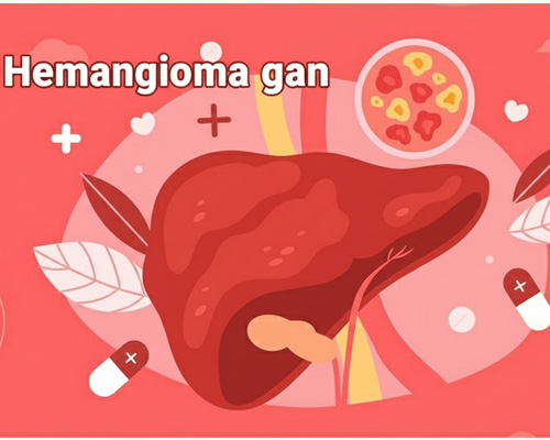 Hemangioma gan là gì? Nguyên nhân, triệu chứng