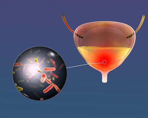 Viêm bàng quang do đâu? Nguyên nhân thường gặp nhất