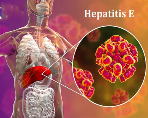 Viêm gan E là gì? Dấu hiệu nhận biết và cách phòng ngừa hiệu quả