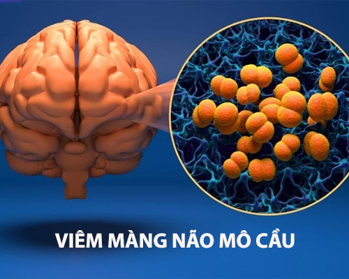 Viêm màng não mô cầu là gì? Nguyên nhân và triệu chứng
