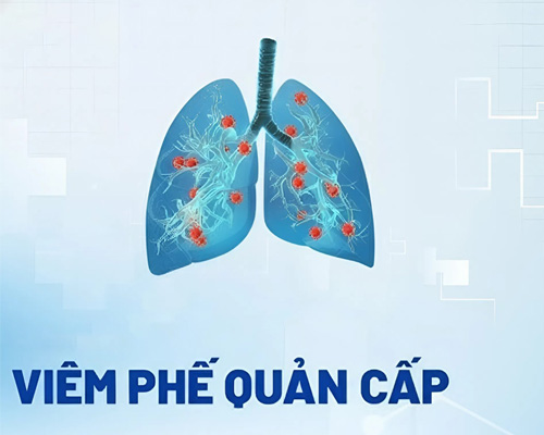 Viêm phế quản cấp bao lâu thì khỏi?