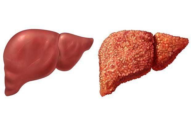 Vôi hóa gan là gì có nguy hiểm không?