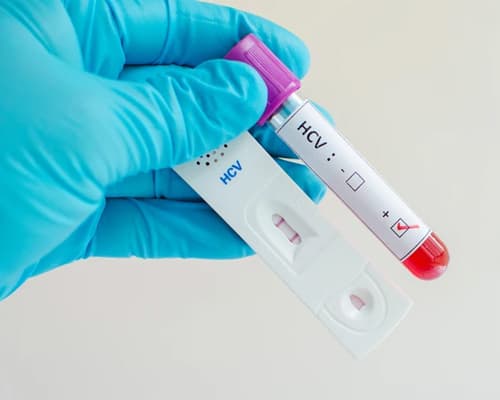 Xét nghiệm HCV Ab là gì? Ý nghĩa, cách đọc kết quả và khi nào cần làm