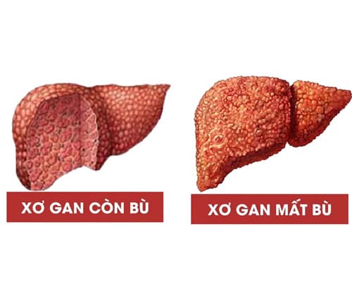 Xơ gan còn bù và xơ gan mất bù khác nhau thế nào?