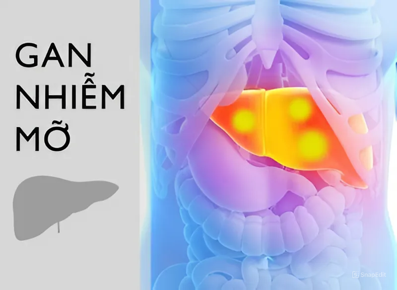 Gan nhiễm mỡ có mấy loại 