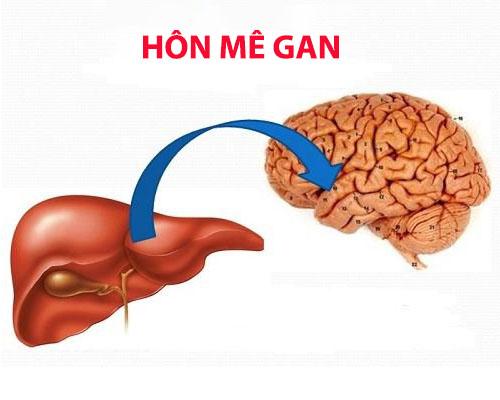 Hôn mê gan là gì