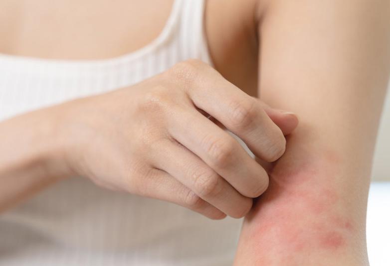 Ngứa ngáy nổi mề đay kéo dài