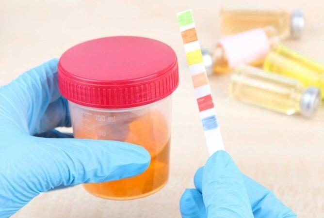 Nước tiểu màu nâu đỏ 