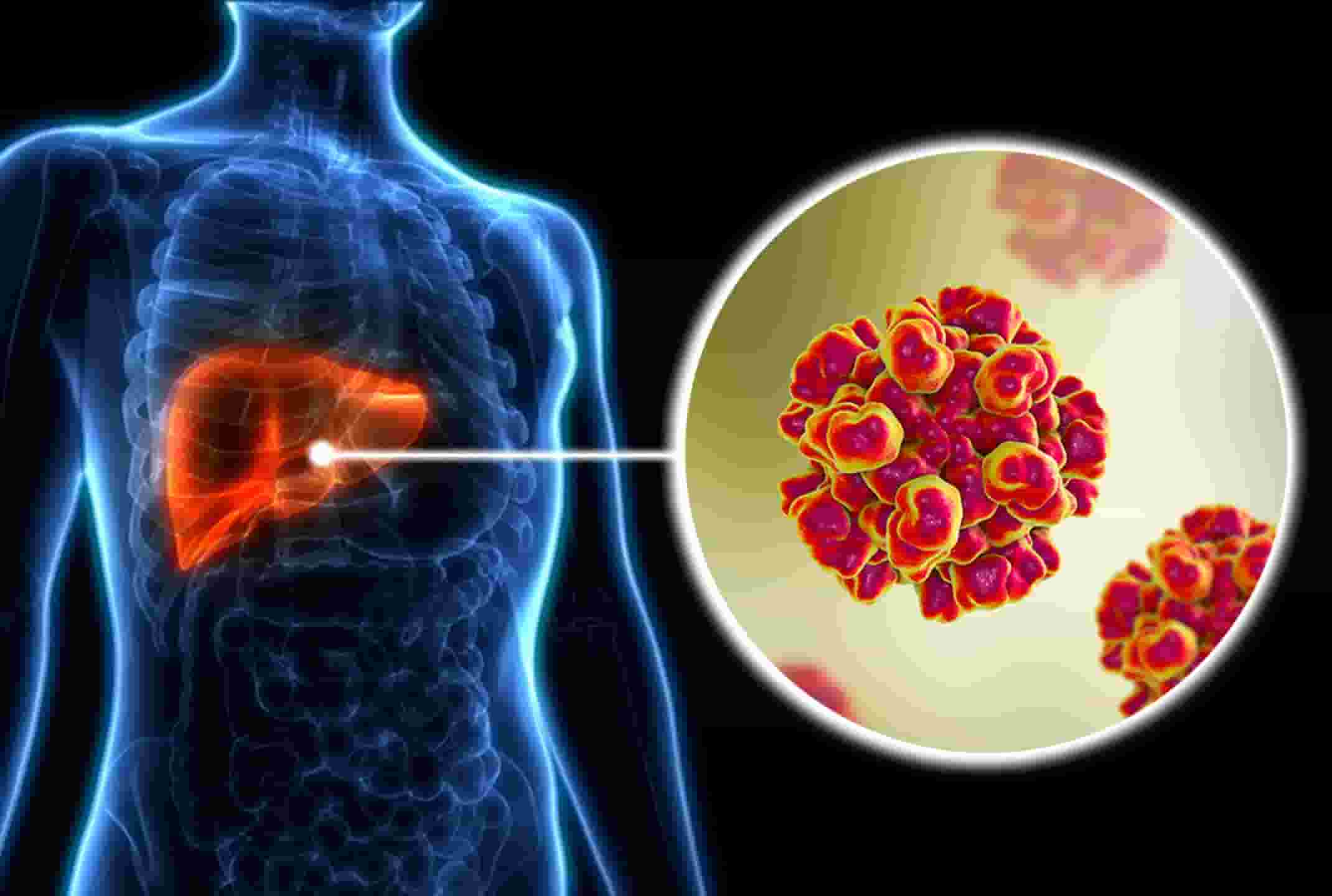 Viêm gan e là gì?