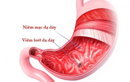 Viêm loét dạ dày mạn tính