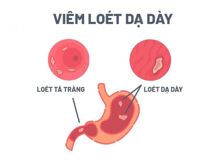 Viêm loét dạ dày tá tràng