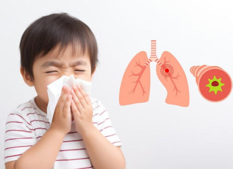 Viêm phế quản cấp ở trẻ em