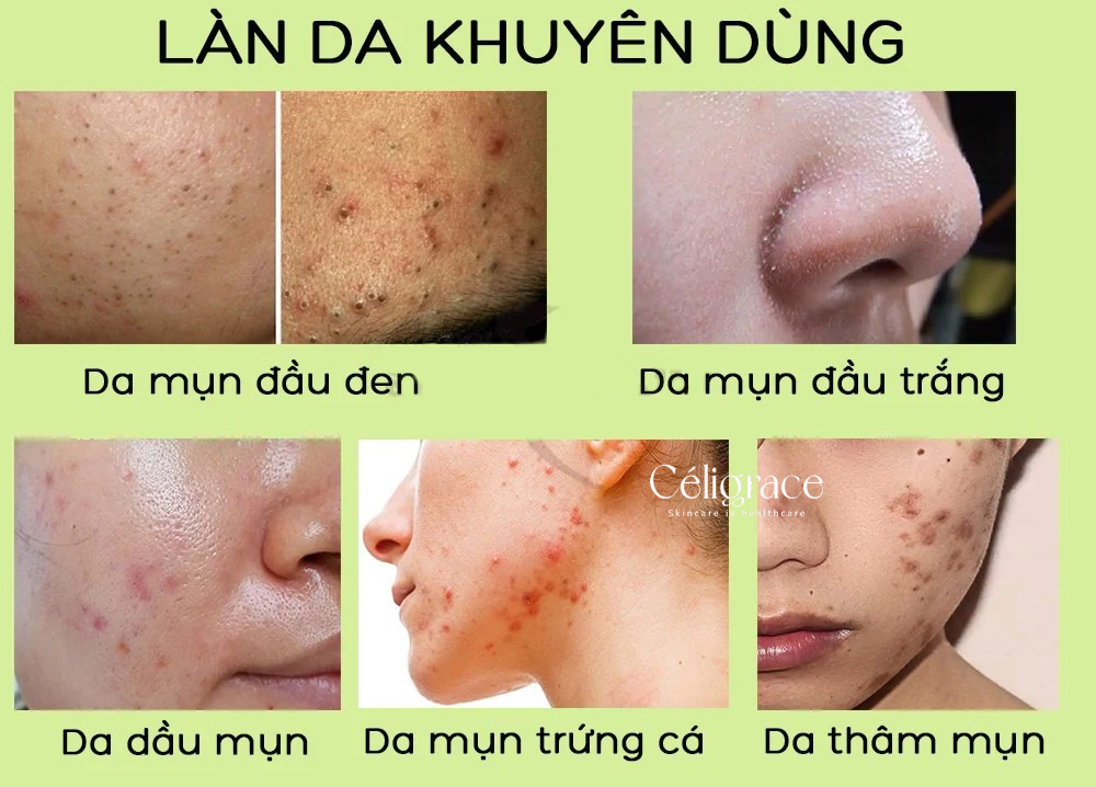 Gel Rửa Mặt SVR Không Chứa Xà Phòng Cho Da Dầu Mụn, Nhạy Cảm Sebiaclear Gel Moussant (Xanh Lá)