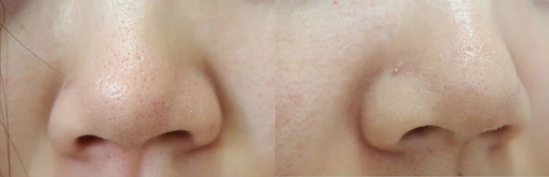 Miếng Dán Hút Mụn Đầu Đen, Sợi Bã Nhờn Ciracle Blackhead Cotton Mask 5ml