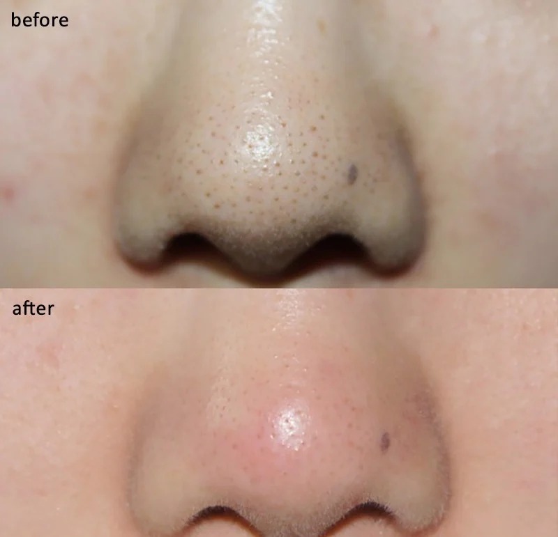 Miếng Dán Hút Mụn Đầu Đen, Sợi Bã Nhờn Ciracle Blackhead Cotton Mask 5ml