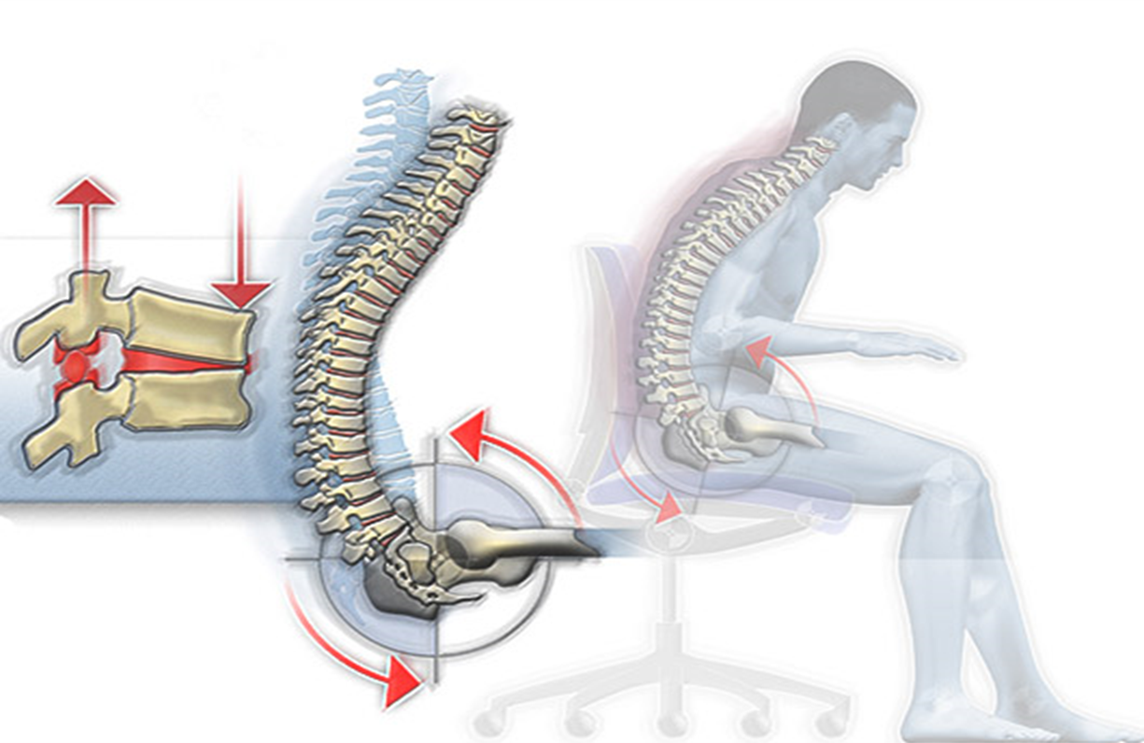THOÁT VỊ ĐĨA ĐỆM – BẠN HOÀN TOÀN CÓ THỂ TỰ HỖ TRỢ ĐIỀU TRỊ TẠI NHÀ NẾU BIẾT RÕ ĐIỀU NÀY
