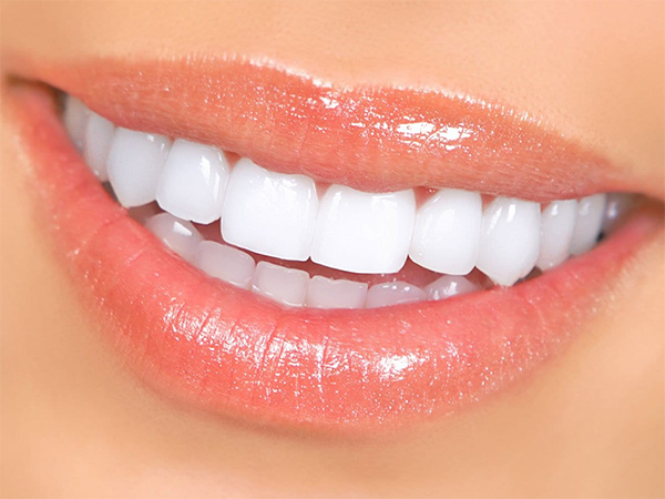 Bọc răng sứ giúp hàng răng trắng đều, có tính thẩm mỹ cao 