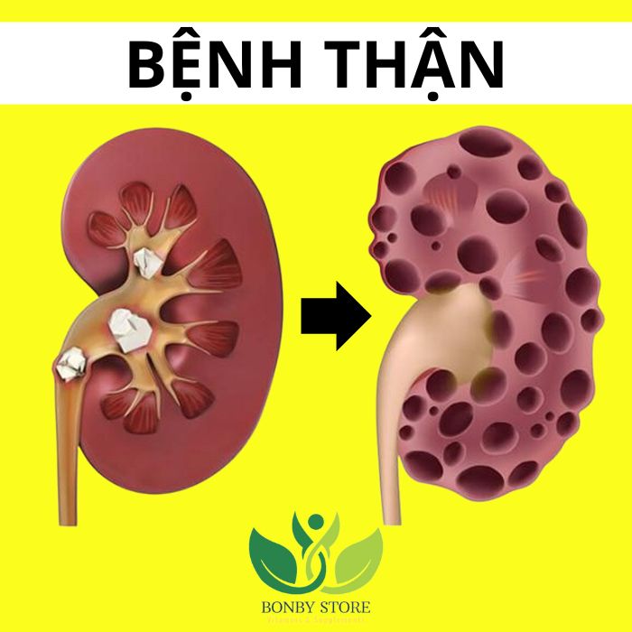 Dấu Hiệu Cảnh Báo Bệnh Thận: Một Số Triệu Chứng Cần Chú Ý