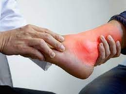 Bệnh Gút Không Còn Là Nỗi Lo Nếu Bạn Biết Cách Giảm Axit Uric