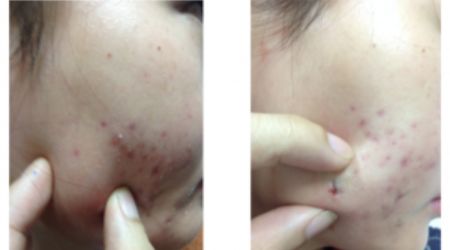 Tiêm Corticoid Nội Tổn Thương