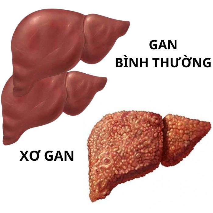 Tại sao cần thải độc gan?