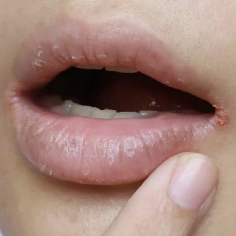 Viêm khoé miệng - Nguyên nhân và cách điều trị!