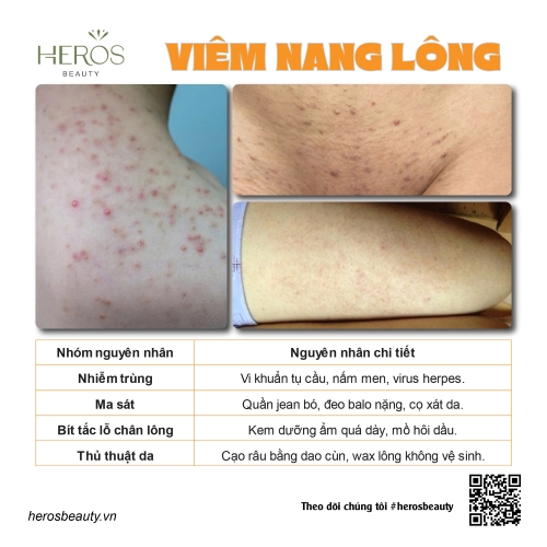 Bạn có biết có nhiều nguyên nhân dẫn tới tình trạng viêm nang lông?