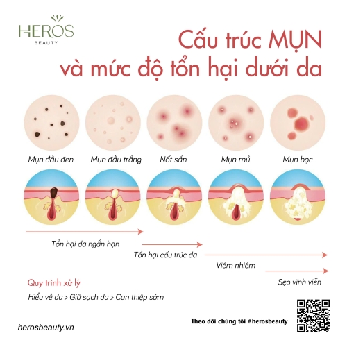 Cấu trúc mụn và mức độ tổn hại dưới da
