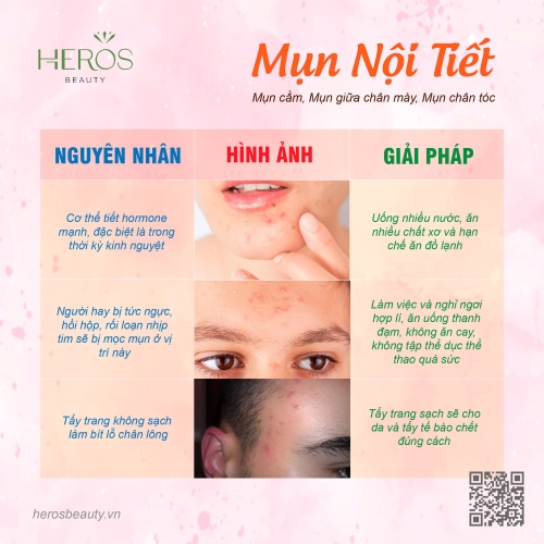 Mụn nội tiết: Nguyên nhân, đặc điểm và giải pháp phòng ngừa
