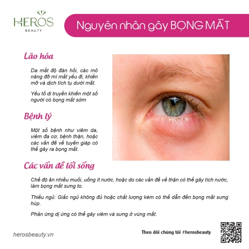 Nguyên nhân gây bọng mắt và bí quyết giúp cải thiện hiệu quả