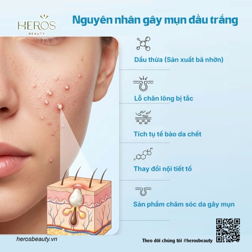 Nguyên nhân chính gây nên mụn đầu trắng