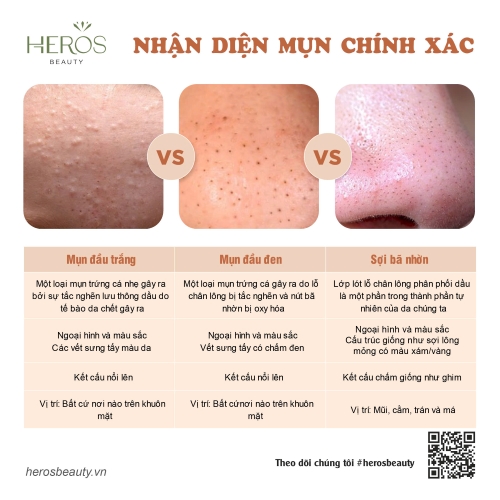 Bật mí bí quyết nhận diện mụn chính xác