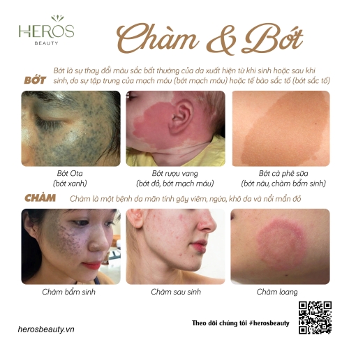 Cách phân biệt các loại chàm và bớt