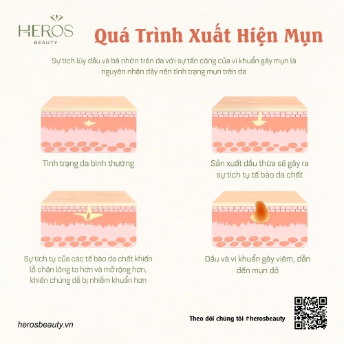 Quá trình xuất hiện mụn và giải pháp ngăn ngừa hiệu quả