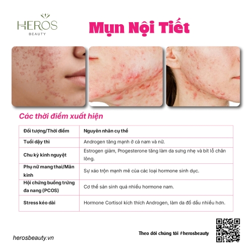 Các thời điểm xuất hiện mụn nội tiết