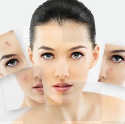 ĐIỀU TRỊ MỤN TẠI SPA
