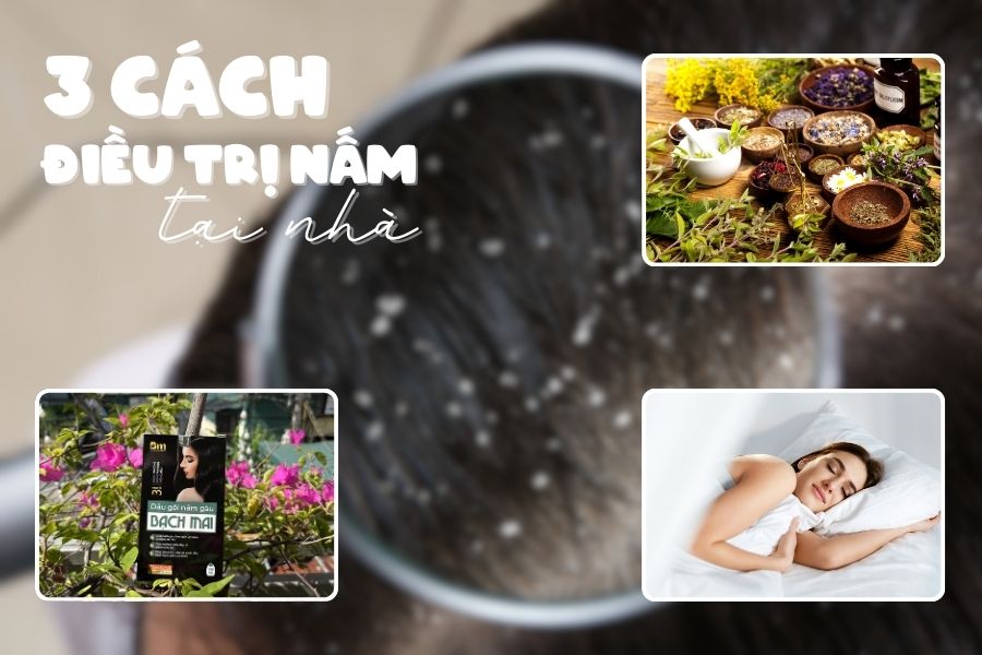 Trị nấm da đầu tại nhà - Những bí quyết đơn giản, đảm bảo hiệu quả