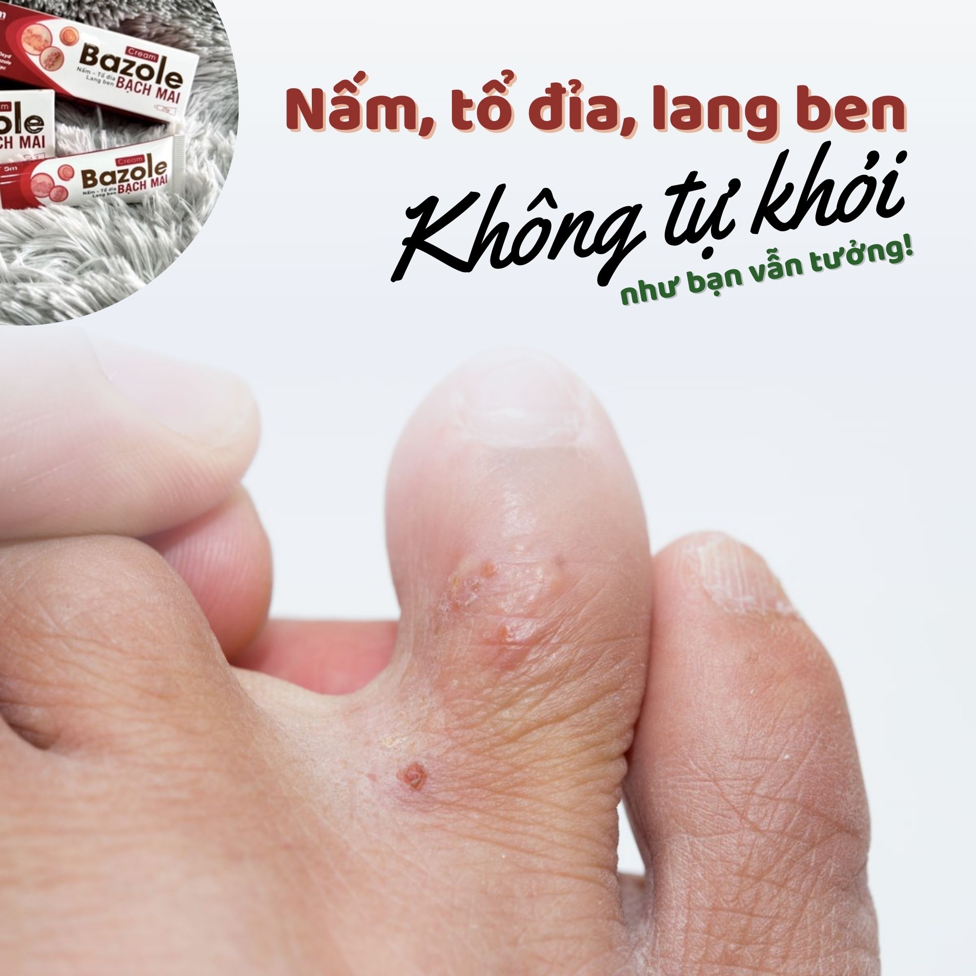 🦠 NẤM, TỔ ĐỈA, LANG BEN 