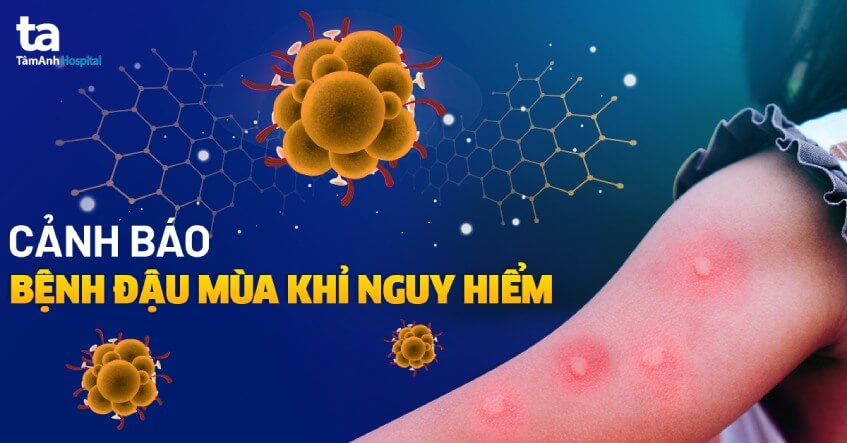CA BỆNH ĐẬU MÙA KHỈ ĐẦU TIÊN TỬ VONG TẠI VIỆT NAM
