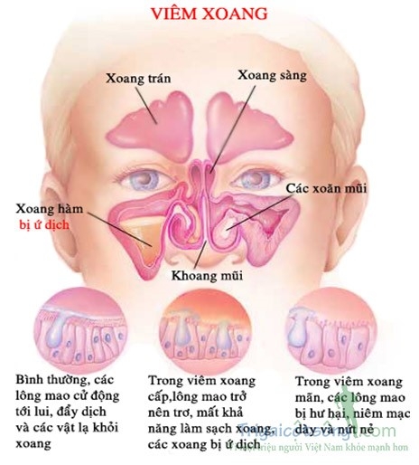 Tại sao viêm xoang lại gây nhức đầu, viêm họng, ù tai?