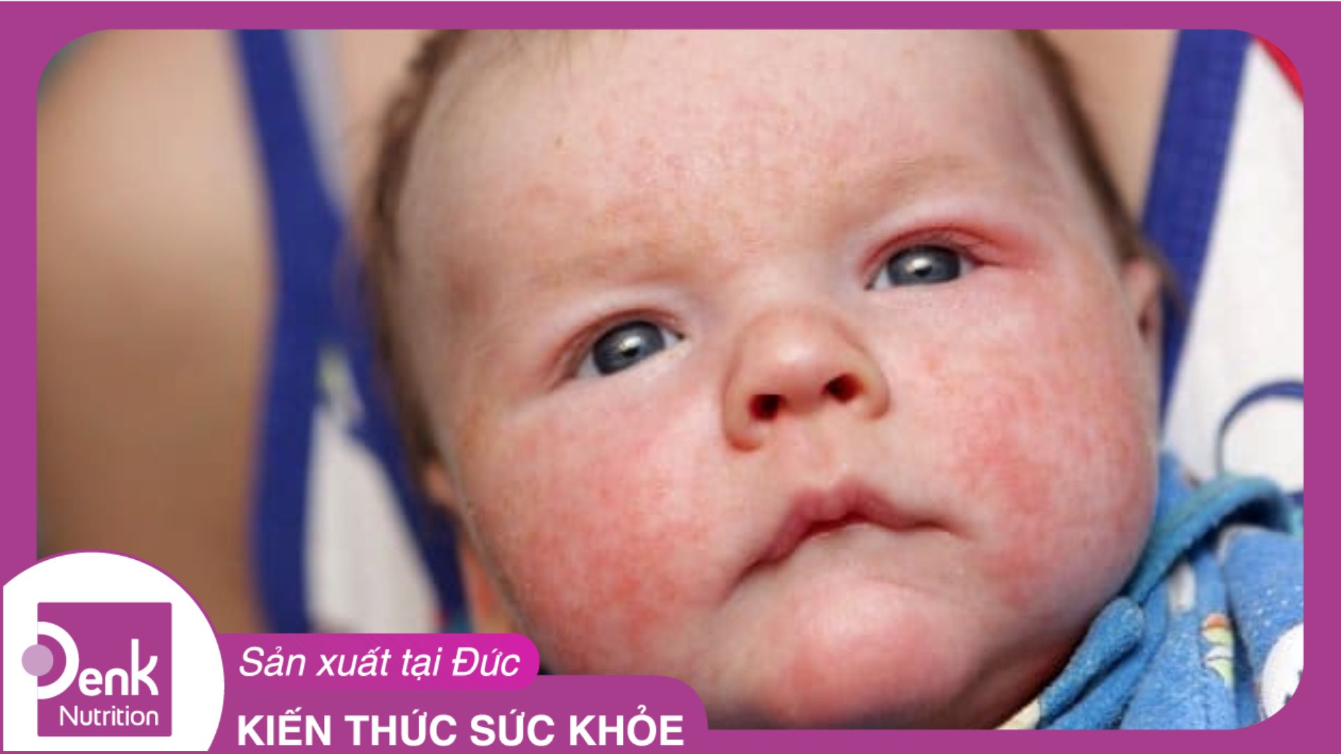 Làm sao để biết bé dị ứng sữa bò và hướng xử lý phù hợp