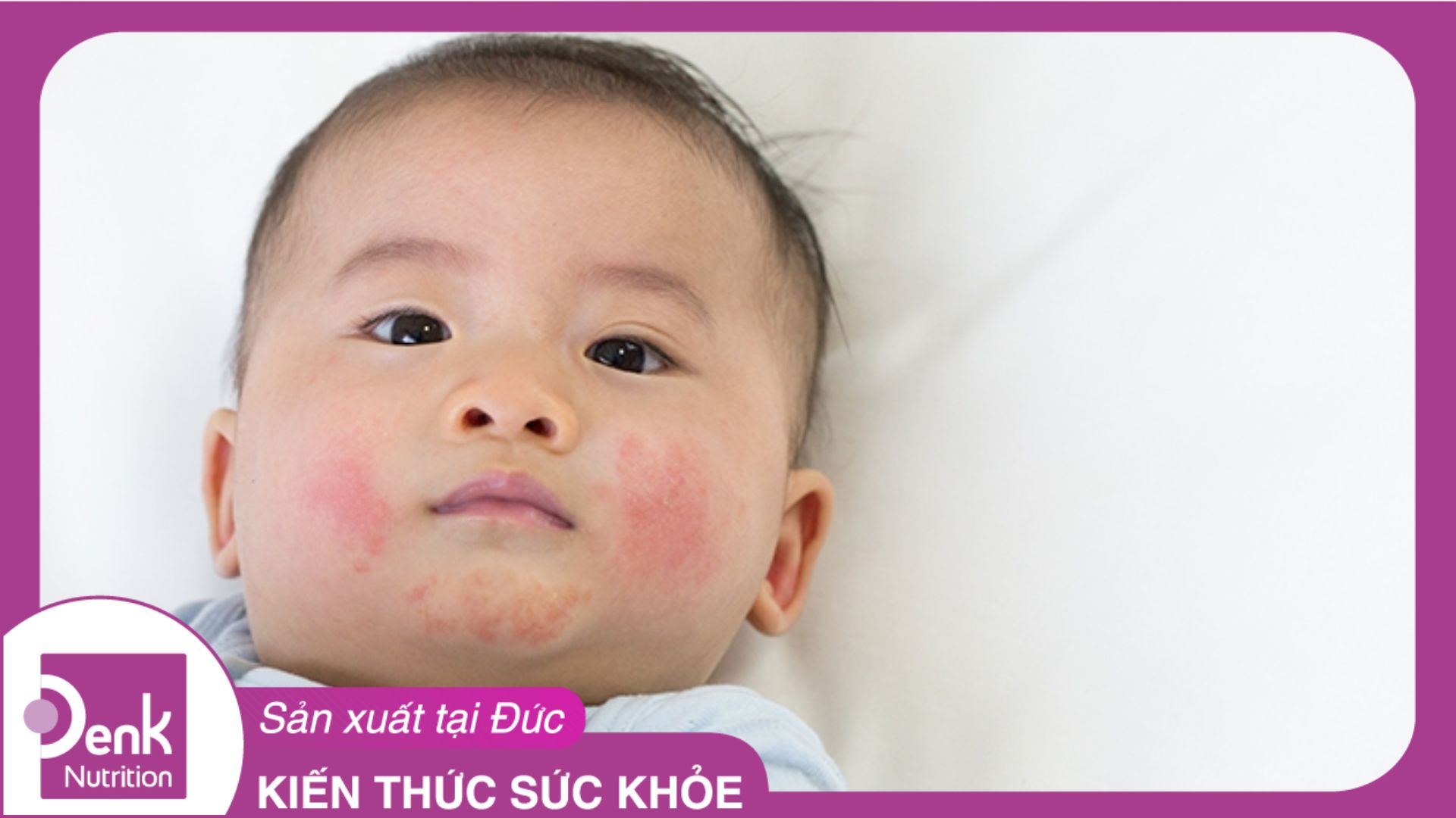 Trẻ bị dị ứng sữa - nguyên nhân và cách xử lý hiệu quả