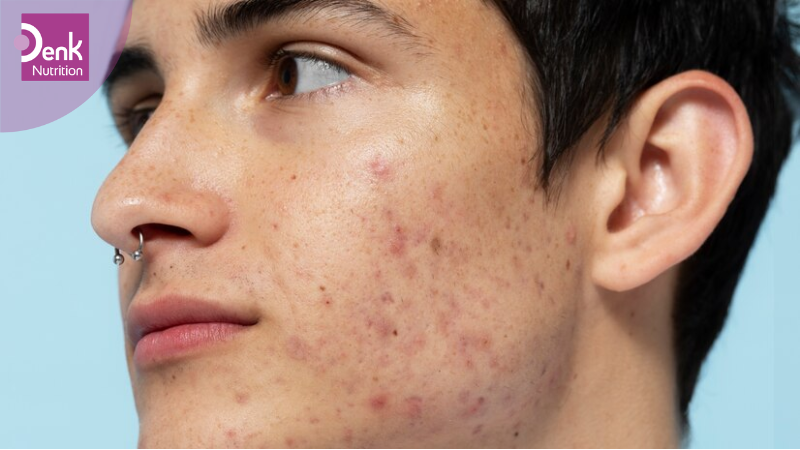 Giúp điều trị mụn trứng cá